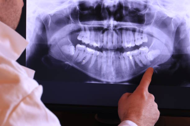 Best Emergency Wisdom Teeth Removal in South El Monte, CA