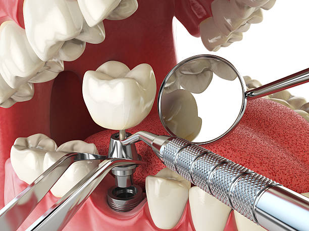 Best Emergency Broken Tooth Repair in South El Monte, CA